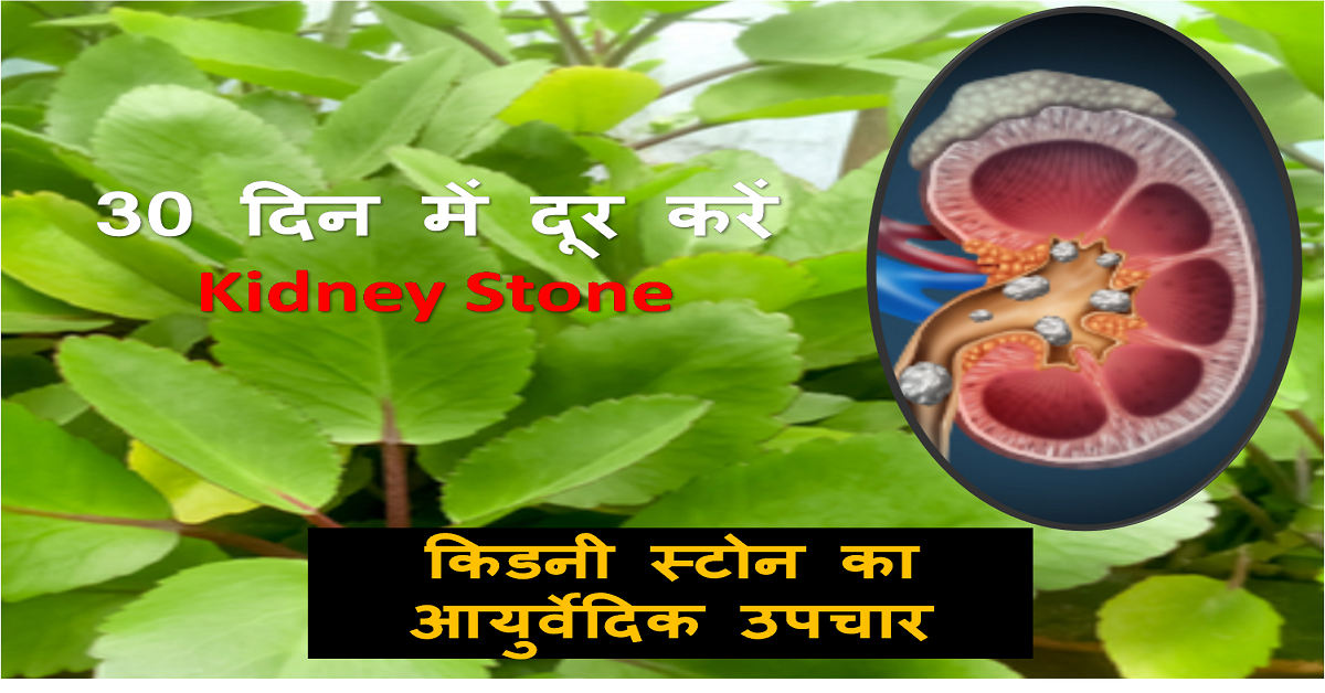 Kidney Stone से हमेशा के लिए छुटकारा कैसे पाएं?